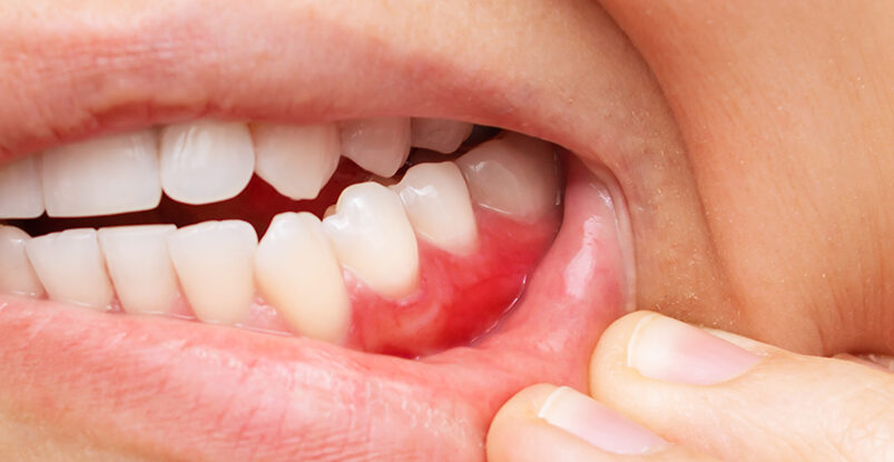 This Popular Diet Seems to Reduce Gum Disease, Scientists Say : ScienceAlert