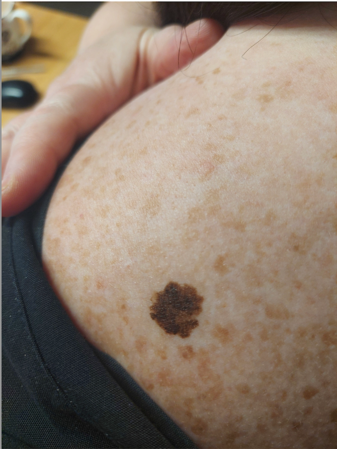 Lynsey Robertson ignored her mole for years